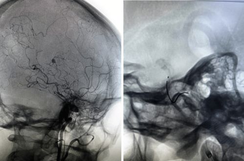 acl surgery post op brace,Acl Surgery Post Op Brace: A Comprehensive Guide